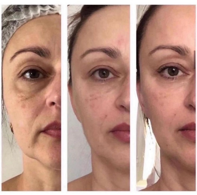 Before and after treatment comparison 1